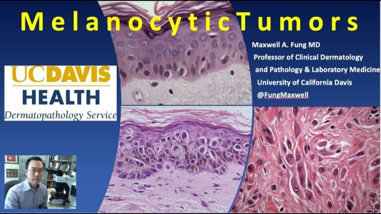 DERMATOPATHOLOGY: Melanocytic Tumors