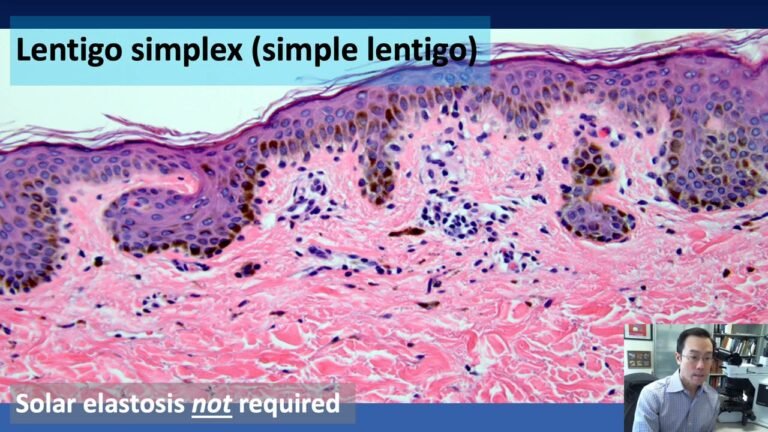 DERMATOPATHOLOGY  Melanocytic Tumors