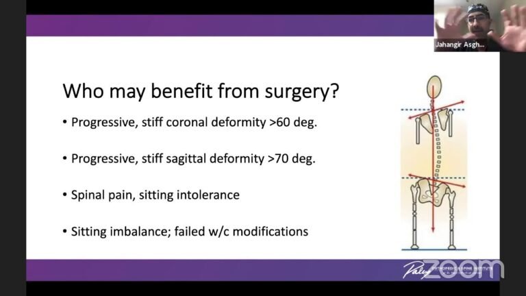 Neuromuscular Scoliosis