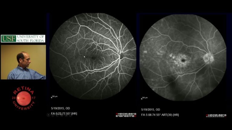 Subretinal Fluid – Ophthalmology Resident Lecture – April, 2018