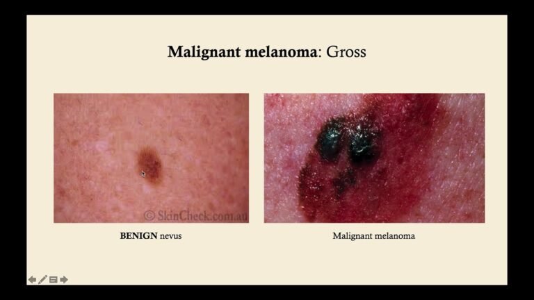 Overview of Skin Cancer – CRASH! Medical Review Series