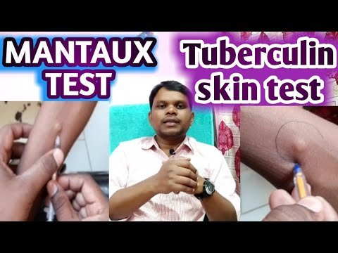 Mantoux test | TST | PPD | Tuberculin skin test | Diagnosis of TB.